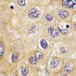 IHC-P analysis of human hepatocarcinoma using GTX81903 Claudin 1 antibody, Loop1. IHC-P analysis of human hepatocarcinoma using GTX81903 Claudin 1 antibody, Loop1.