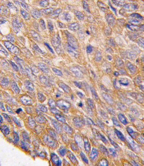 IHC-P analysis of human lung carcinoma using GTX81931 TOB2 antibody, N-term. IHC-P analysis of human lung carcinoma using GTX81931 TOB2 antibody, N-term.