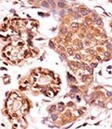 IHC-P analysis of human breast carcinoma using GTX81938 c-Abl (phospho Tyr412) Antibody. IHC-P analysis of human breast carcinoma using GTX81938 c-Abl (phospho Tyr412) Antibody.