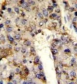 IHC-P analysis of human hepatocarcinoma using GTX81941 hnRNP L antibody, Internal. IHC-P analysis of human hepatocarcinoma using GTX81941 hnRNP L antibody, Internal.