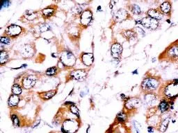 IHC-P analysis of human hepatocellular carcinoma using GTX82520 HDBP2 antibody, Internal. IHC-P analysis of human hepatocellular carcinoma using GTX82520 HDBP2 antibody, Internal.
