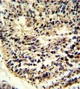 IHC-P analysis of human lung carcinoma using GTX82541 Bcl2A1 antibody, Internal. IHC-P analysis of human lung carcinoma using GTX82541 Bcl2A1 antibody, Internal.