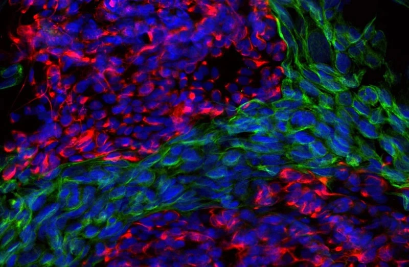 ICC/IF analysis of PC-12 cells using GTX82614 Peripherin antibody [7C5]. Red : Primary antibody Green : Vimentin Blue : Hoechst Dilution : 1:500