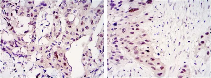 IHC-P analysis of mammary cancer tissue (left) and lung cancer tissue (right) using GTX82752 STAT3 antibody [3B5].