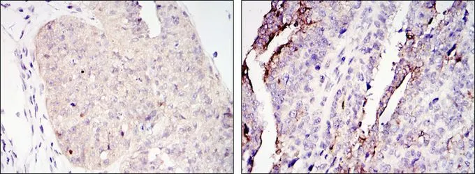 IHC-P analysis of ovary tumour tissue (left) and lung cancer (right) using GTX82754 TORC2 antibody [5B10].