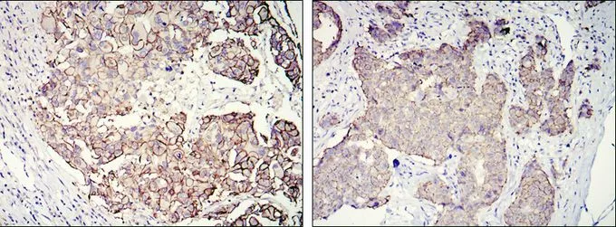 IHC-P analysis of galactophore tumour using GTX82764 Her2 / ErbB2 antibody [6C2].