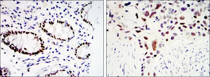 IHC-P analysis of colon cancer tissue (left) and lung cancer tissue (right) using GTX82771 KLF4 antibody [1E6].