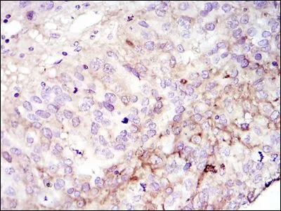IHC-P analysis of cervices tumour using GTX82780 FAK antibody [10H7].