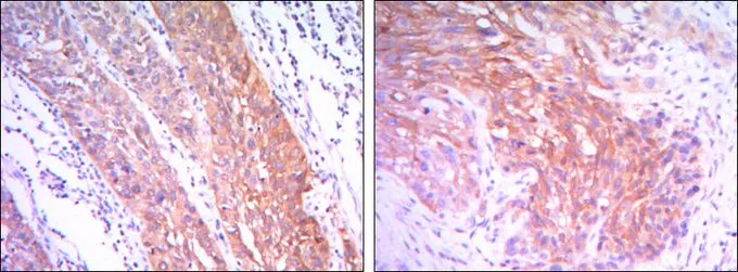 IHC-P analysis of esophagus cancer tissue (left) and human lung cancer (right) using GTX82791 Hexokinase II antibody [3D3].