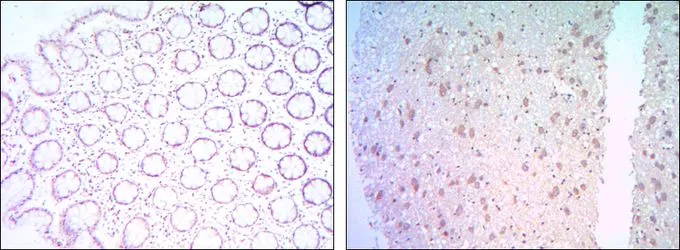 IHC-P analysis of colon cancer tissue (left) and human brain tissue (right) using GTX82803 Bcl-2 antibody [8E12].