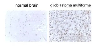 IHC-P analysis of normal brain and gliobastoma multiform tissue using GTX82986 LC3B antibody.
