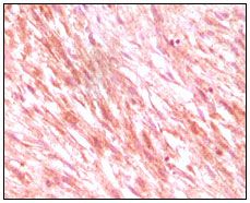 IHC-P analysis of maligant mesenchymoma tissue using GTX83074 c-Kit antibody [8D7].