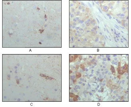IHC-P analysis of human brain hippocampus (A), lung cancer (B), brain tumor (C), breast cancer (D) using GTX83088 alpha B Crystallin antibody [1D11C6E6].