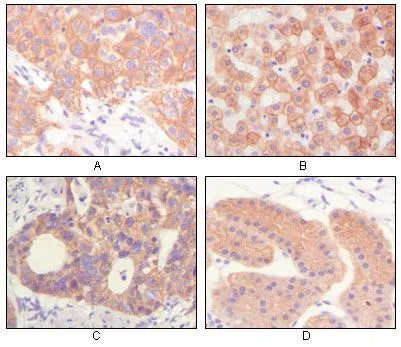 IHC-P analysis of human lung squamous cell carcinoma (A),normal hepatocyte (B), colon adenocacinoma, normal stomach tissue (D) using GTX83116 pan Cytokeratin antibody [7H8].