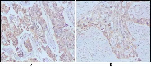 IHC-P analysis of human breast cancer(A), lung tissue(B) using GTX83138 EGF antibody [9D7F11].
