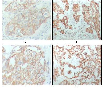 IHC-P analysis of human breast carcinoma (A), lung cancer (B) and ovarian cancer tissue (C) using GTX83140 Cytokeratin 8 antibody [8A5D12].