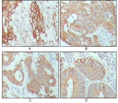 IHC-P analysis of human breast carcinoma (A), hepatocarcinoma (B), stomach cancer (C) and colon cancer tissue (D) using GTX83142 Cytokeratin 18 antibody [4D11E4].