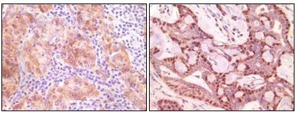IHC-P analysis of human ovary carcinoma (left) and breast carcinoma (right) using GTX83156 gamma Synuclein antibody [1H10D2].