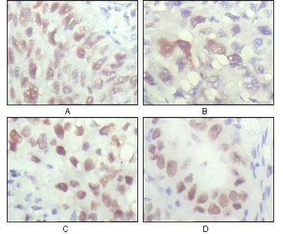 IHC-P analysis of human lung carcinoma (A), liver carcinoma (B), breast carcinoma (C) and kiney carcinoma (D) using GTX83198 Chk2 antibody [1C12B8].