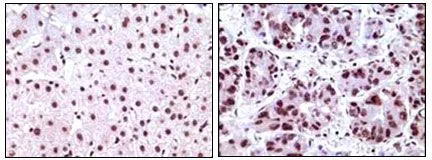 IHC-P analysis of human liver carcinoma tissue using GTX83217 Nucleophosmin antibody [7H10B9].