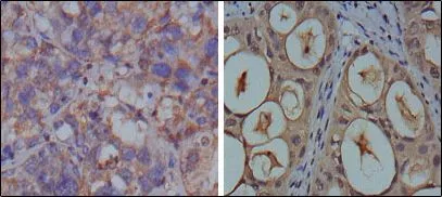 IHC-P analysis of human breast carcinoma (left) and kidney carcinoma (right) using GTX83245 GAPDH antibody [1A10].