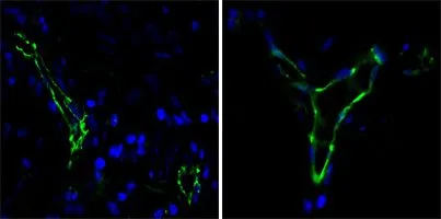 IHC-P analysis of human lung cancer(left) and breast cancer(right) cells using GTX83248 CD31 antibody [2F7B2]. Green : CD31 Blue: DRAQ5 fluorescent DNA dye