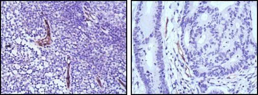 IHC-P analysis of human lymph node (left) and colon cancer (right) tissue using GTX83305 eNOS antibody [6H2].