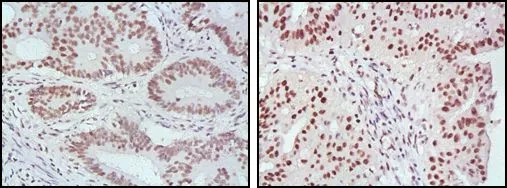 IHC-P analysis of human rectum cancer (left) and ovarian cancer (right) tissue using GTX83336 MLH1 antibody [4C9C7].