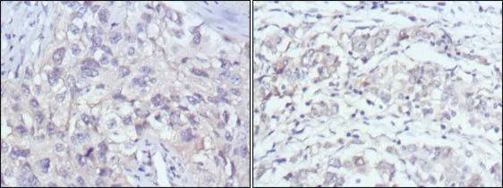 IHC-P analysis of human lung cancer (left) and gastric cancer (right) using GTX83373 PAK2 antibody [3B5].