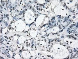 IHC-P analysis of colon adenocarcinoma tissue using GTX83406 XRCC4 antibody [4H9]. Antigen retrieval : Heat-induced epitope retrieval by 10mM citrate buffer, pH6.0, 100oC for 10min. Dilution : 1:50