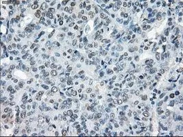 IHC-P analysis of endometrium adenocarcinoma tissue using GTX83406 XRCC4 antibody [4H9]. Antigen retrieval : Heat-induced epitope retrieval by 10mM citrate buffer, pH6.0, 100oC for 10min. Dilution : 1:50