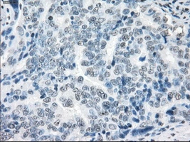 IHC-P analysis of human ovary adenocarcinoma tissue using GTX83406 XRCC4 antibody [4H9]. Antigen retrieval : Heat-induced epitope retrieval by 10mM citrate buffer, pH6.0, 100oC for 10min. Dilution : 1:50