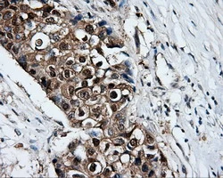 IHC-P analysis of human breast adenocarcinoma tissue using GTX83411 XRCC1 antibody [2D8]. Antigen retrieval : Heat-induced epitope retrieval by 10mM citrate buffer, pH6.0, 100oC for 10min.