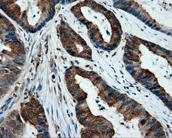 IHC-P analysis of human colon adenocarcinoma tissue using GTX83411 XRCC1 antibody [2D8]. Antigen retrieval : Heat-induced epitope retrieval by 10mM citrate buffer, pH6.0, 100oC for 10min.