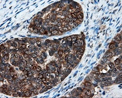 IHC-P analysis of human ovary adenocarcinoma tissue using GTX83411 XRCC1 antibody [2D8]. Antigen retrieval : Heat-induced epitope retrieval by 10mM citrate buffer, pH6.0, 100oC for 10min.