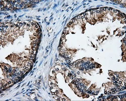 IHC-P analysis of human prostate tissue using GTX83411 XRCC1 antibody [2D8]. Antigen retrieval : Heat-induced epitope retrieval by 10mM citrate buffer, pH6.0, 100oC for 10min.