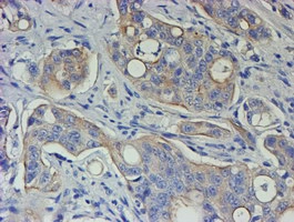 IHC-P analysis of human pancreas carcinoma tissue using GTX83425 VEGFA antibody [4G3].