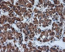 IHC-P analysis of liver carcinoma tissue using GTX83463 alpha Tubulin 8 antibody [3E10]. Antigen retrieval : Heat-induced epitope retrieval by 10mM citrate buffer, pH6.0, 100oC for 10min. Dilution : 1:50