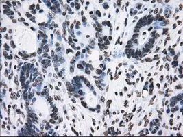 IHC-P analysis of colon adenocarcinoma tissue using GTX83473 TTLL12 antibody [4B2]. Antigen retrieval : Heat-induced epitope retrieval by 10mM citrate buffer, pH6.0, 100oC for 10min. Dilution : 1:50
