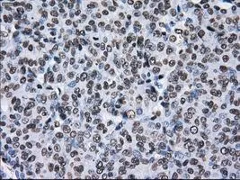 IHC-P analysis of endometrium adenocarcinoma tissue using GTX83473 TTLL12 antibody [4B2]. Antigen retrieval : Heat-induced epitope retrieval by 10mM citrate buffer, pH6.0, 100oC for 10min. Dilution : 1:50