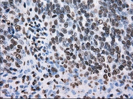 IHC-P analysis of human ovary adenocarcinoma tissue using GTX83473 TTLL12 antibody [4B2]. Antigen retrieval : Heat-induced epitope retrieval by 10mM citrate buffer, pH6.0, 100oC for 10min. Dilution : 1:50