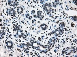 IHC-P analysis of breast tissue using GTX83473 TTLL12 antibody [4B2]. Antigen retrieval : Heat-induced epitope retrieval by 10mM citrate buffer, pH6.0, 100oC for 10min. Dilution : 1:50