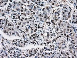 IHC-P analysis of liver carcinoma tissue using GTX83473 TTLL12 antibody [4B2]. Antigen retrieval : Heat-induced epitope retrieval by 10mM citrate buffer, pH6.0, 100oC for 10min. Dilution : 1:50