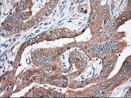 IHC-P analysis of human colon adenocarcinoma tissue using GTX83482 TTC32 antibody [5C12]. Antigen retrieval : Heat-induced epitope retrieval by 10mM citrate buffer, pH6.0, 100oC for 10min. Dilution : 1:50