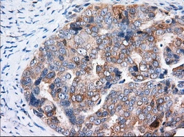IHC-P analysis of human ovary adenocarcinoma tissue using GTX83482 TTC32 antibody [5C12]. Antigen retrieval : Heat-induced epitope retrieval by 10mM citrate buffer, pH6.0, 100oC for 10min. Dilution : 1:50