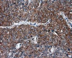 IHC-P analysis of endometrium adenocarcinoma tissue using GTX83498 TPMT antibody [2A2]. Antigen retrieval : Heat-induced epitope retrieval by 10mM citrate buffer, pH6.0, 100oC for 10min. Dilution : 1:50