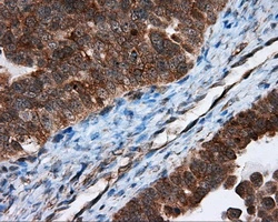 IHC-P analysis of human ovary adenocarcinoma tissue using GTX83498 TPMT antibody [2A2]. Antigen retrieval : Heat-induced epitope retrieval by 10mM citrate buffer, pH6.0, 100oC for 10min. Dilution : 1:50