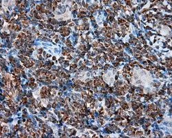 IHC-P analysis of thyroid carcinoma tissue using GTX83498 TPMT antibody [2A2]. Antigen retrieval : Heat-induced epitope retrieval by 10mM citrate buffer, pH6.0, 100oC for 10min. Dilution : 1:50