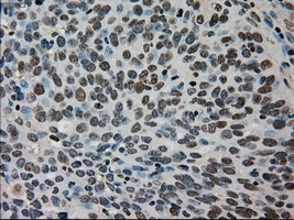 IHC-P analysis of human ovary adenocarcinoma tissue using GTX83509 TMEM100 antibody [2D3]. Antigen retrieval : Heat-induced epitope retrieval by 10mM citrate buffer, pH6.0, 100oC for 10min. Dilution : 1:50