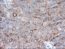 IHC-P analysis of human ovary adenocarcinoma tissue using GTX83533 TACC3 antibody [7B11]. Antigen retrieval : Heat-induced epitope retrieval by 10mM citrate buffer, pH6.0, 100oC for 10min. Dilution : 1:50